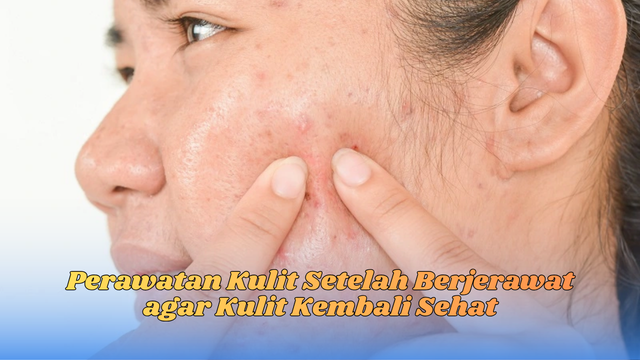 Perawatan Kulit Setelah Berjerawat